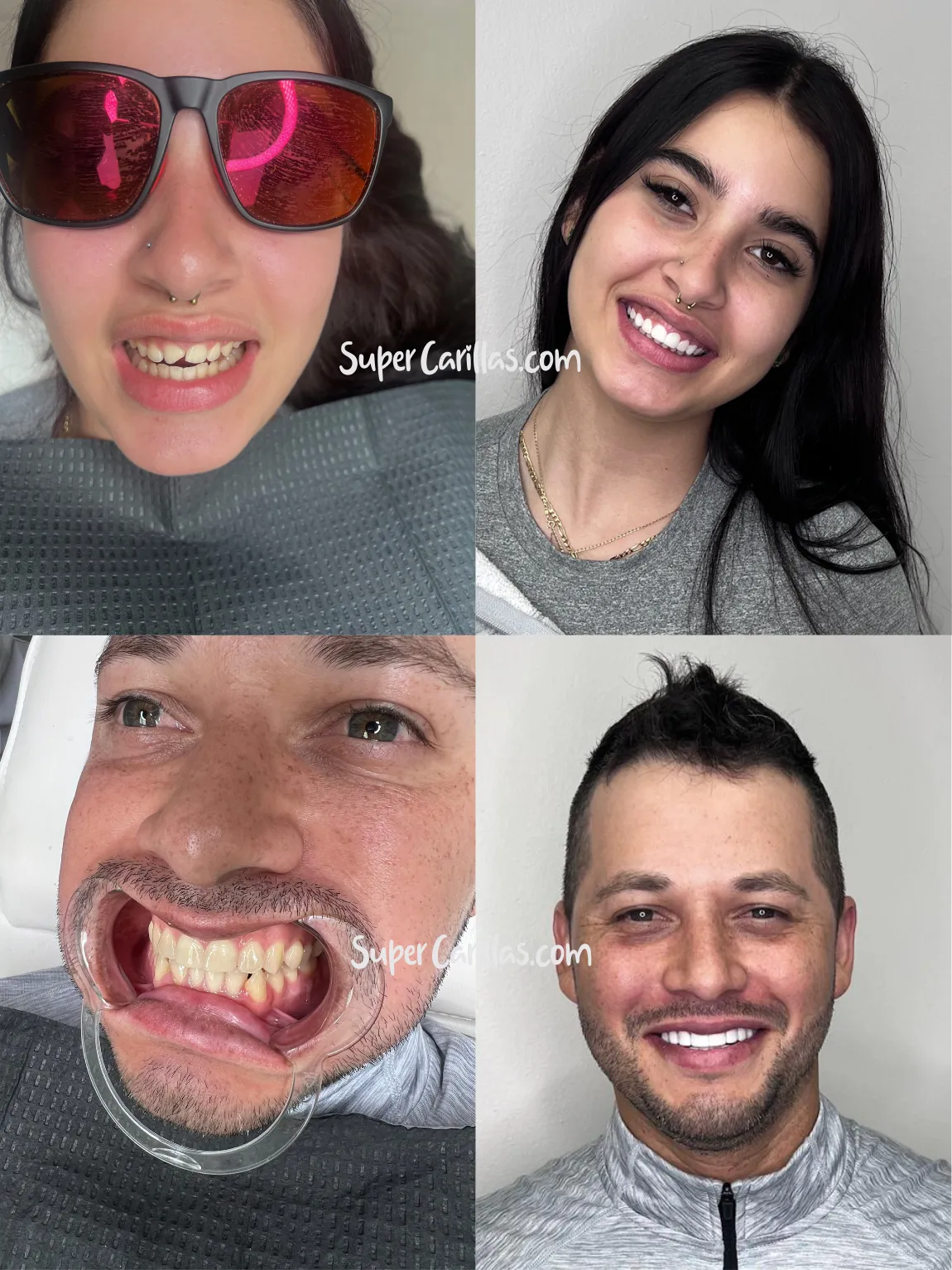 Direct composite veneers before and after in Miami and Orlando