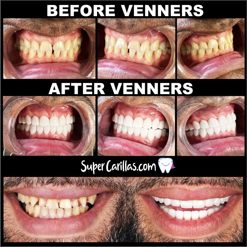 Dental veneers in Miami with porcelain and composite options