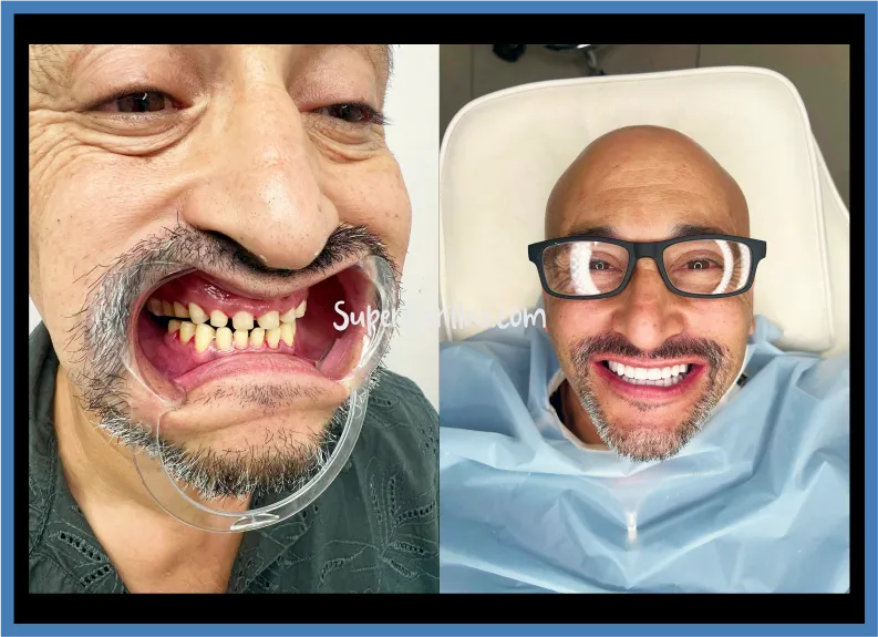 Resin veneers in Miami | SuperCarillas Resin veneer smile in Miami - Before and after