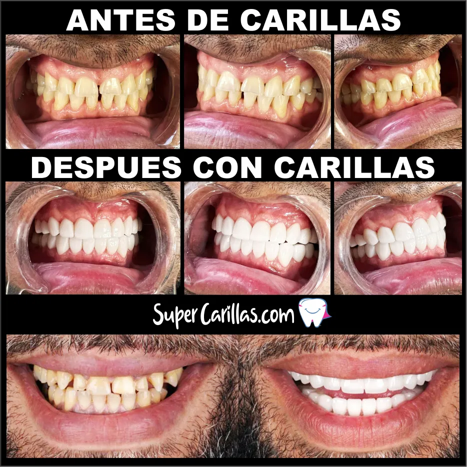 Precios de carillas dentales en Miami: resina y porcelana