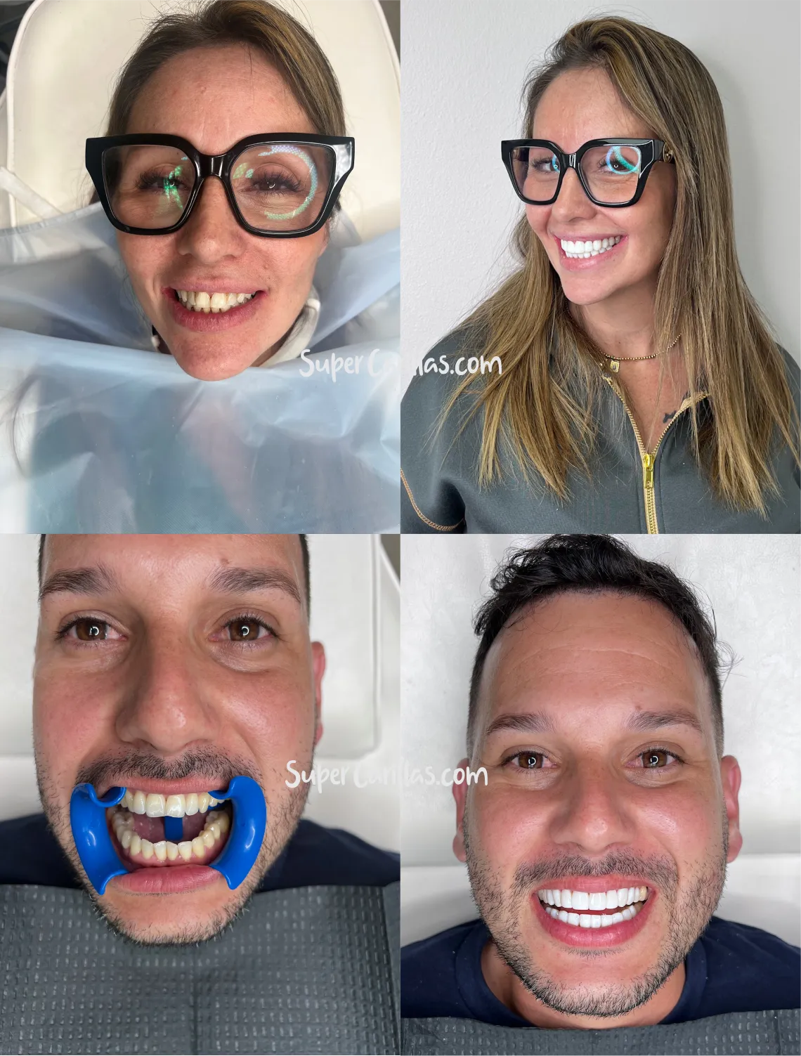 Carillas de porcelana en Miami y Orlando - Antes y después