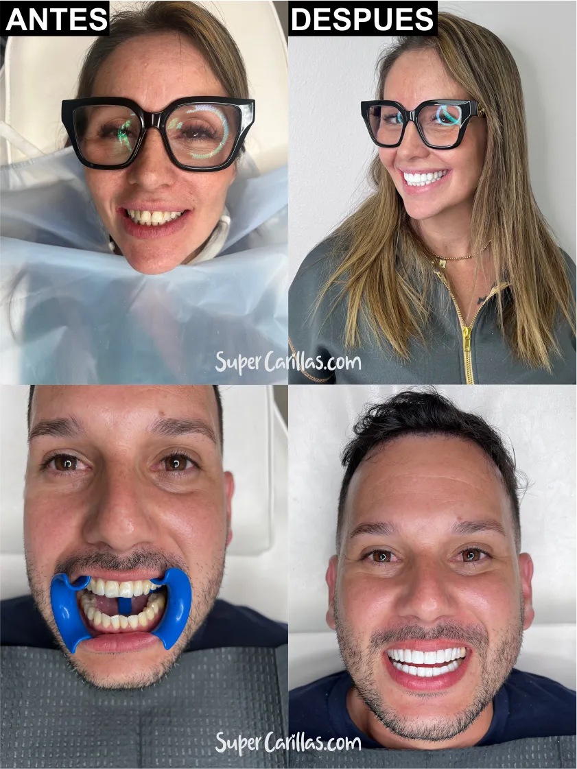 Antes y después de carillas de porcelana - sonrisa transformada