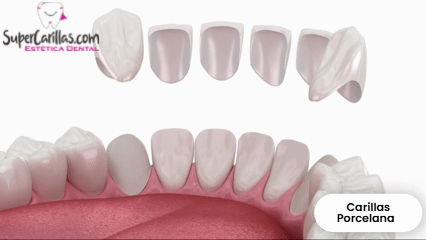 precios de carillas dentales en porcelana