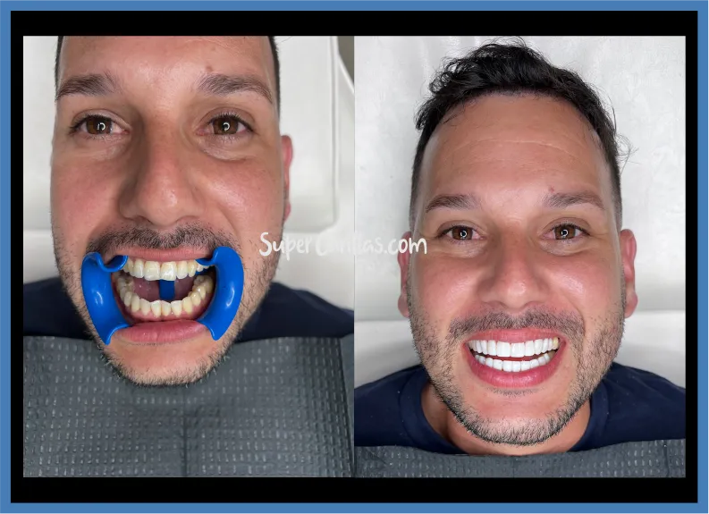 Cosmetic veneers in Miami | SuperCarillas Cosmetic veneers in Miami - Before and after