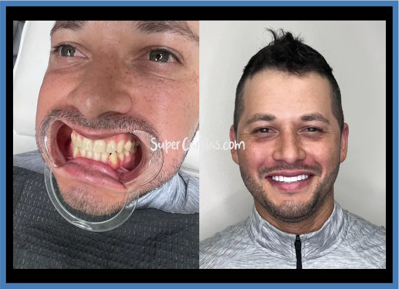 Dental correction in Miami | SuperCarillas Dental correction with veneers in Miami - Before and after