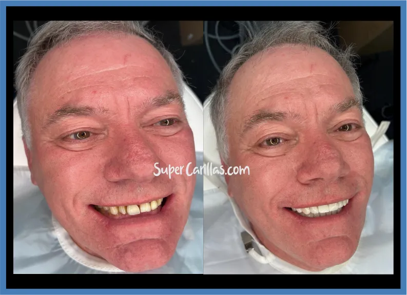 Veneer results in Miami | SuperCarillas Dental veneer results in Miami - Before and after