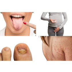 Combate la Candidiasis