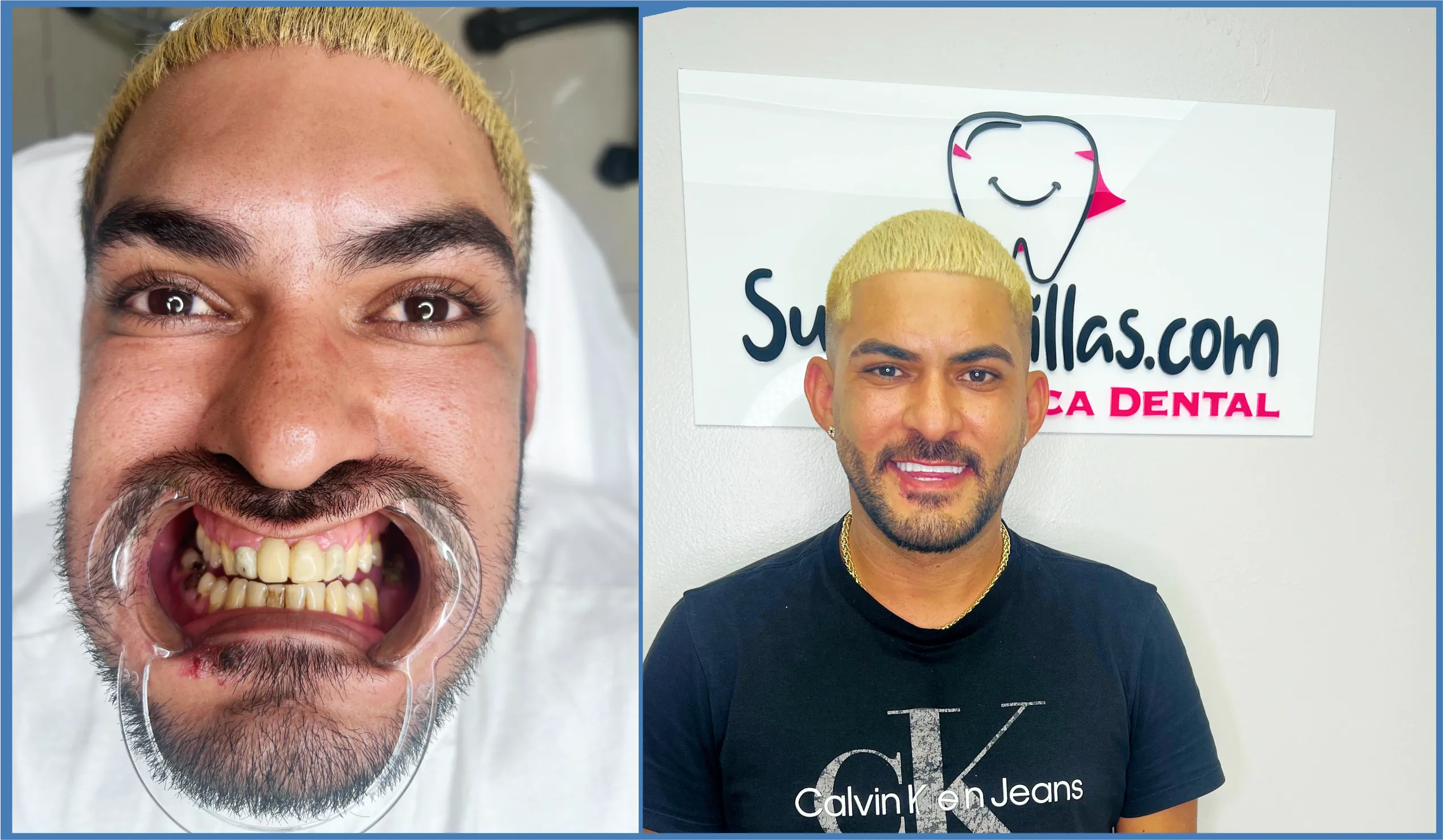 Before and after porcelain and resin dental veneers in Miami