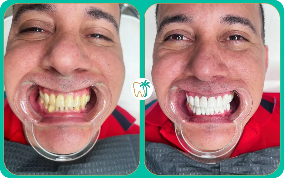 Antes y después con carillas en Miami: cambio estético personalizado (caso real)