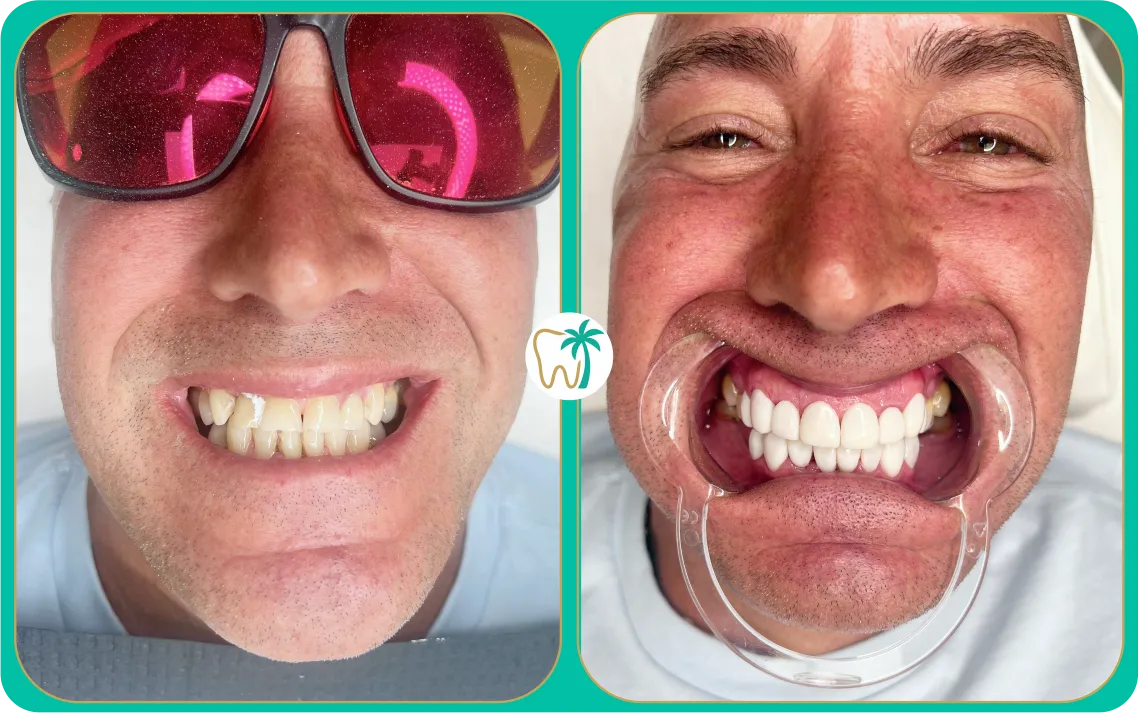 Antes y después con carillas en Miami: mejora de proporción y simetría dental (caso real)