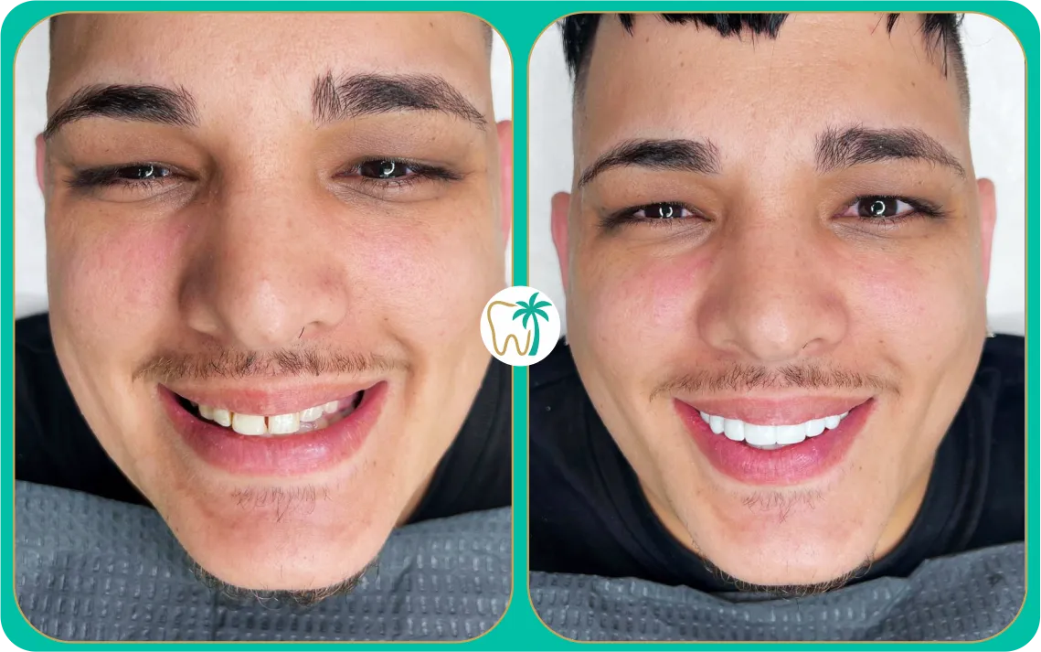 Antes y después con carillas dentales en Miami: caso real en paciente adulto