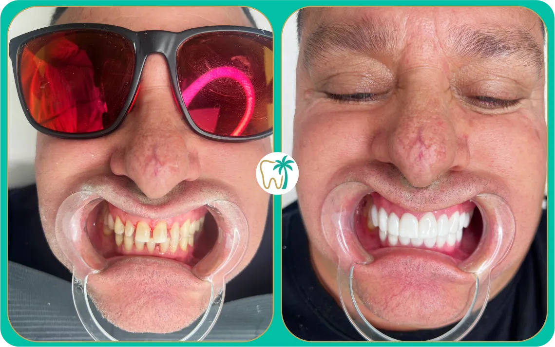 Antes y después con carillas en Miami: resultados individuales (caso real)