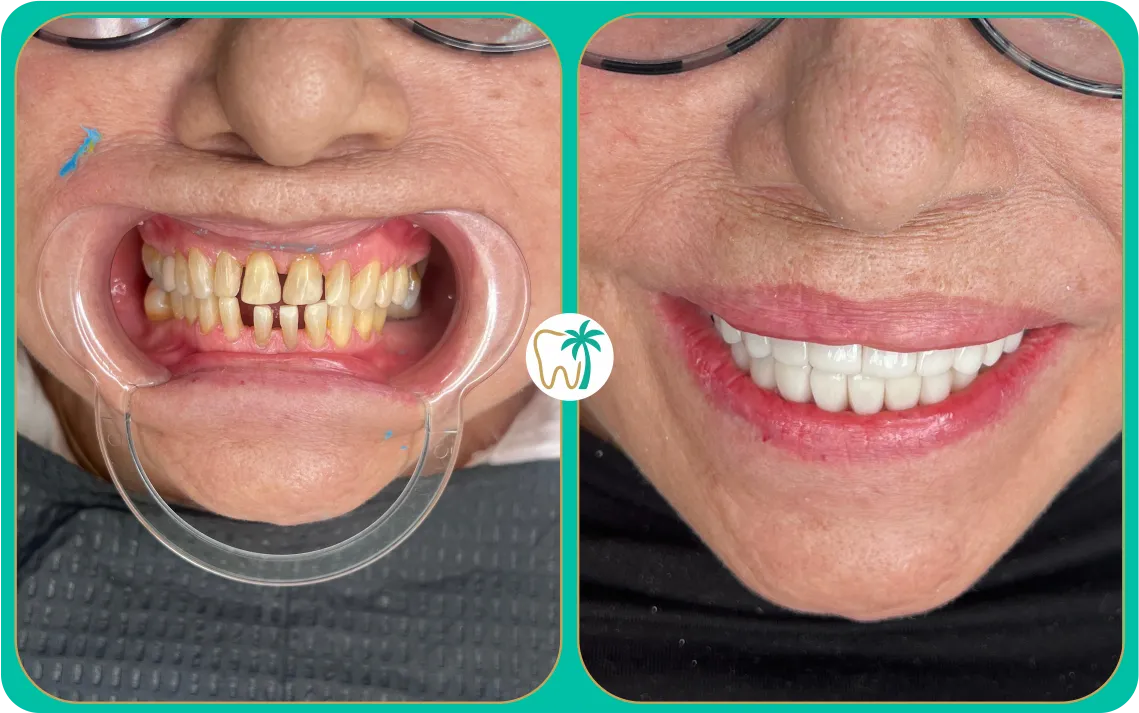 Antes y después con carillas en Miami: mejora estética de alineación según evaluación (caso real)