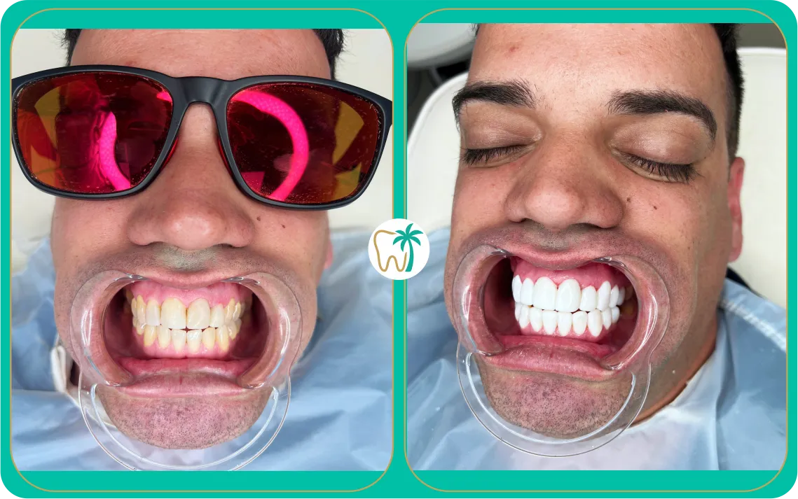 Antes y después con carillas en Miami: acabado estético natural (caso real)