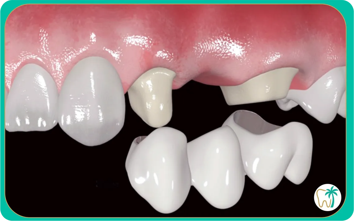 Coronas dentales en porcelana en Miami con enfoque estético y funcional.