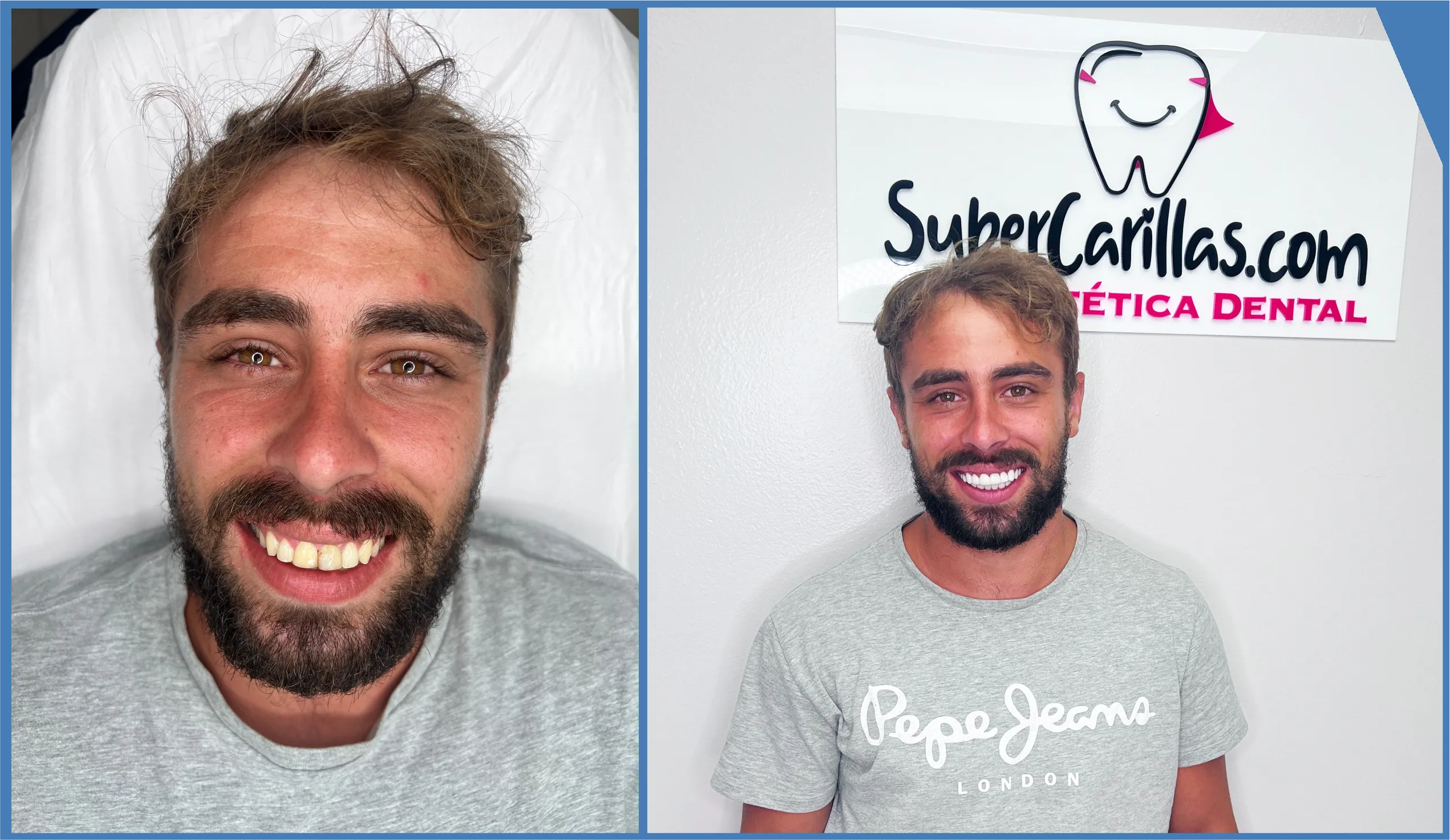Before and after porcelain dental veneers in Miami