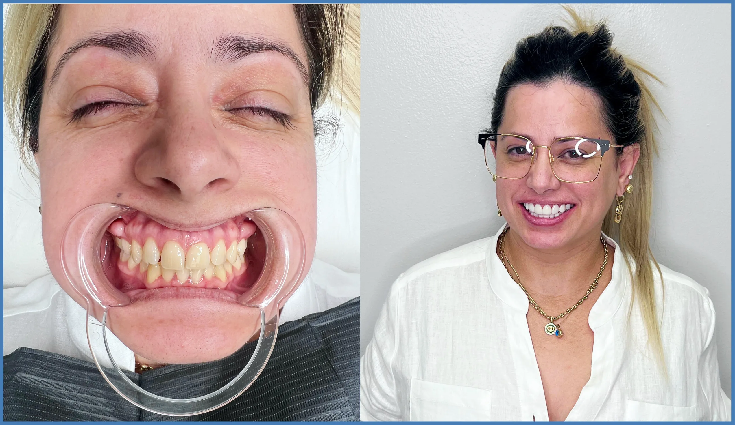 Before and after resin dental veneers in Miami