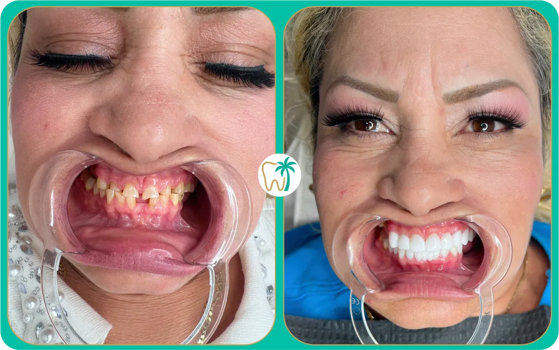 Antes y después con coronas estéticas en Miami: restauración dental (caso real)