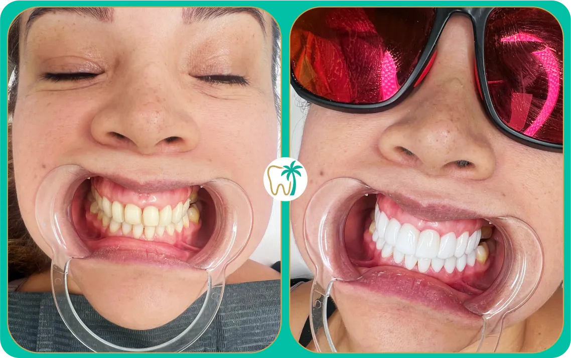 Antes y después con carillas dentales estéticas en Miami: mejora de armonía y proporción (caso real)