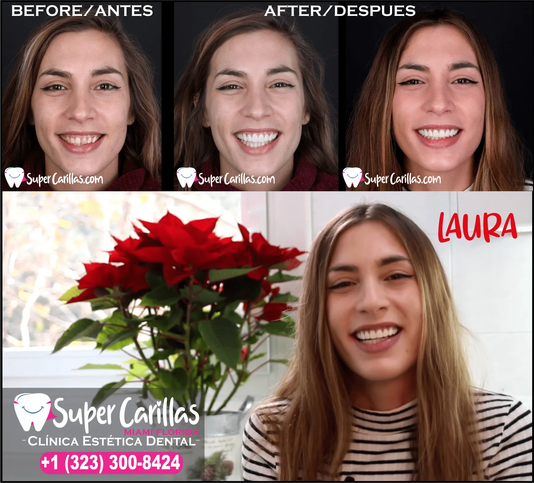 paciente sonriendo tras ponerse carillas de resina en miami