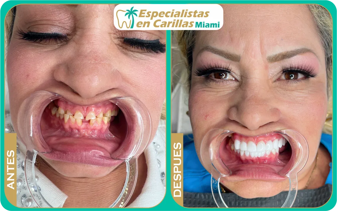 Carillas de porcelana en Miami con resultados naturales y brillo perfecto.