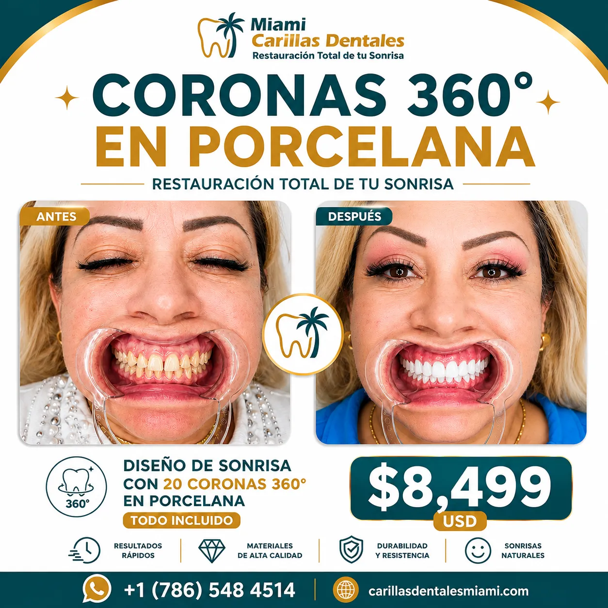 Coronas dentales en porcelana en Miami con enfoque estético y funcional.