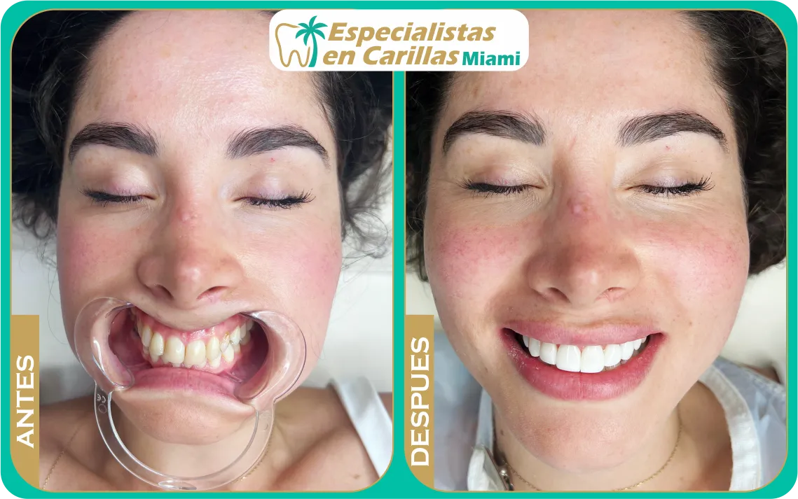 carillas en resina antes y después ver imágenes