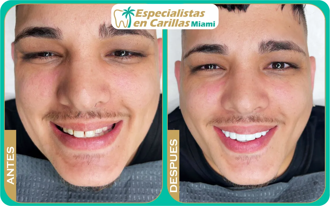 Carillas sin tallado – resultados inmediatos