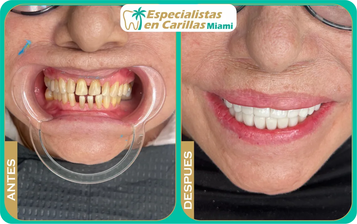 Carillas para dientes torcidos sin ortodoncia – Miami