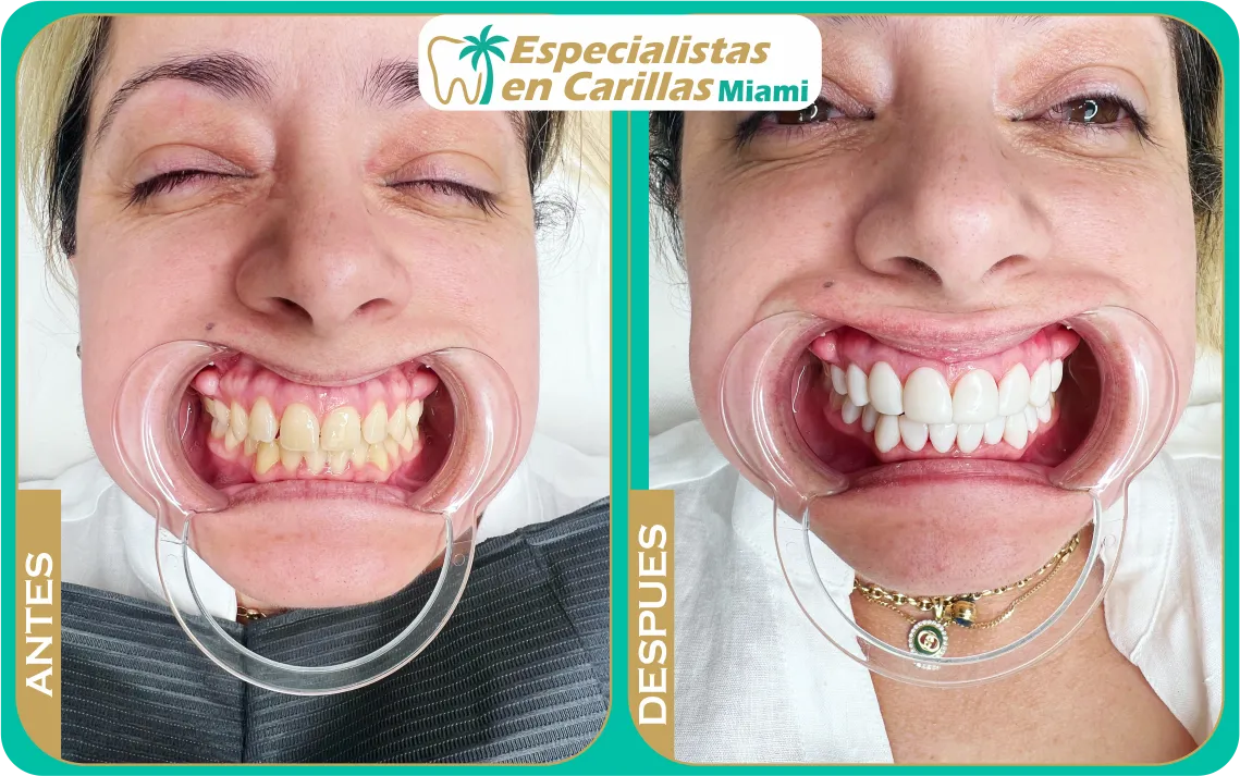 Corrección de dientes desgastados con carillas – Miami