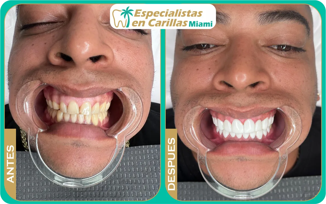 Caso de carillas en hombre joven Miami – mejora dental estética