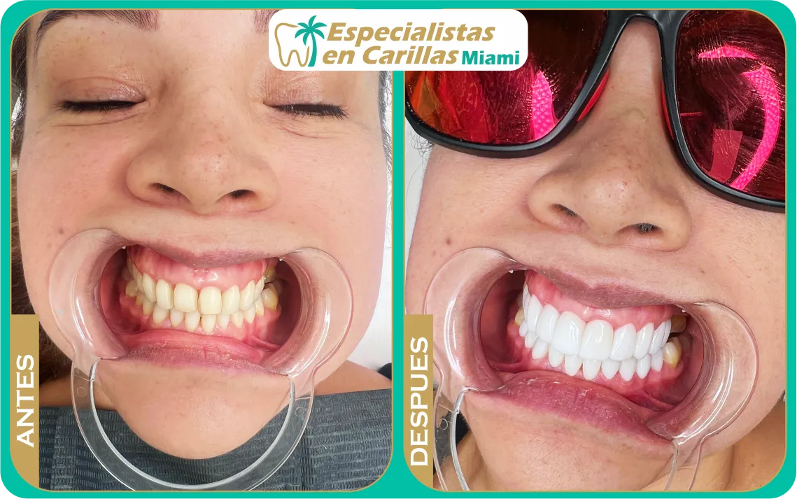 Cambio de sonrisa con carillas dentales estéticas en Miami – resultados naturales