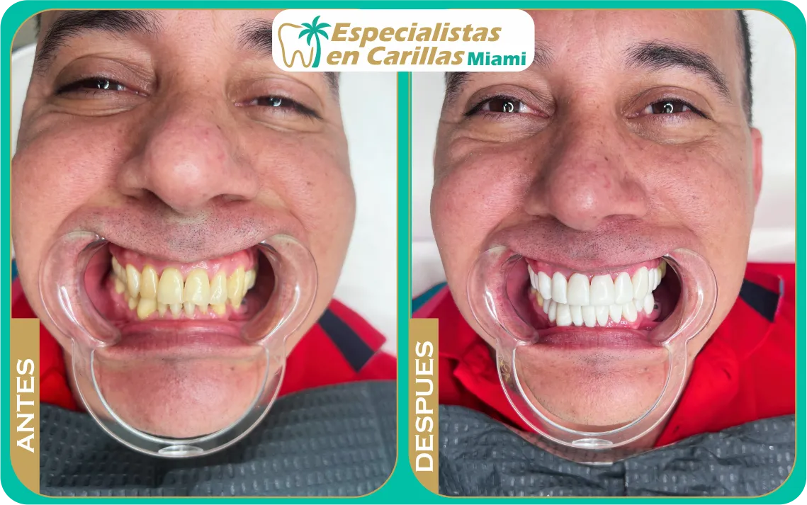 Carillas de resina alta estética – armonía dental