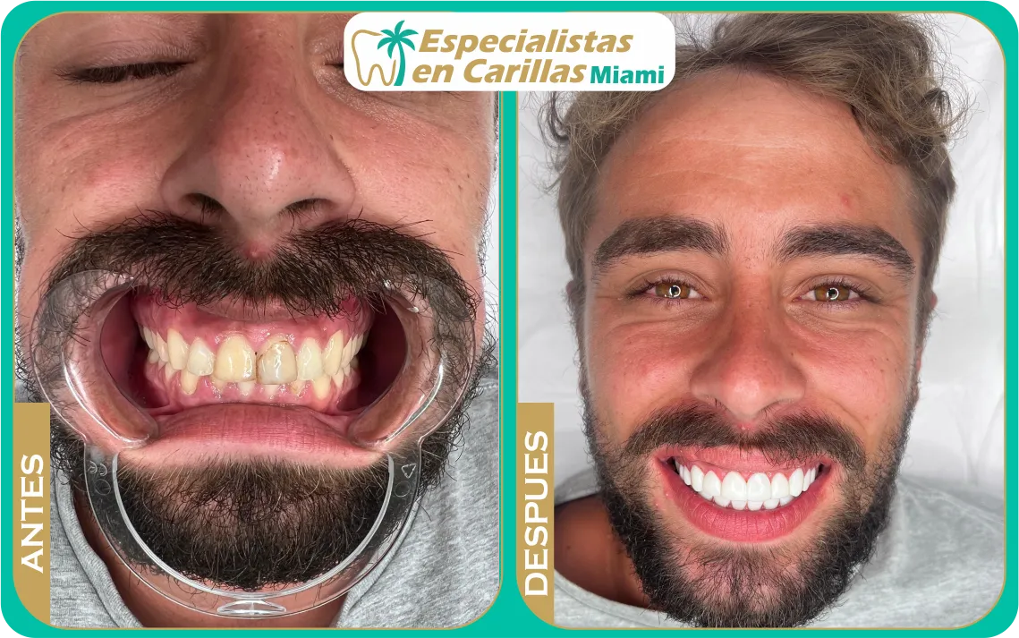 Antes y después de carillas de porcelana en Miami – sonrisa blanca y alineada