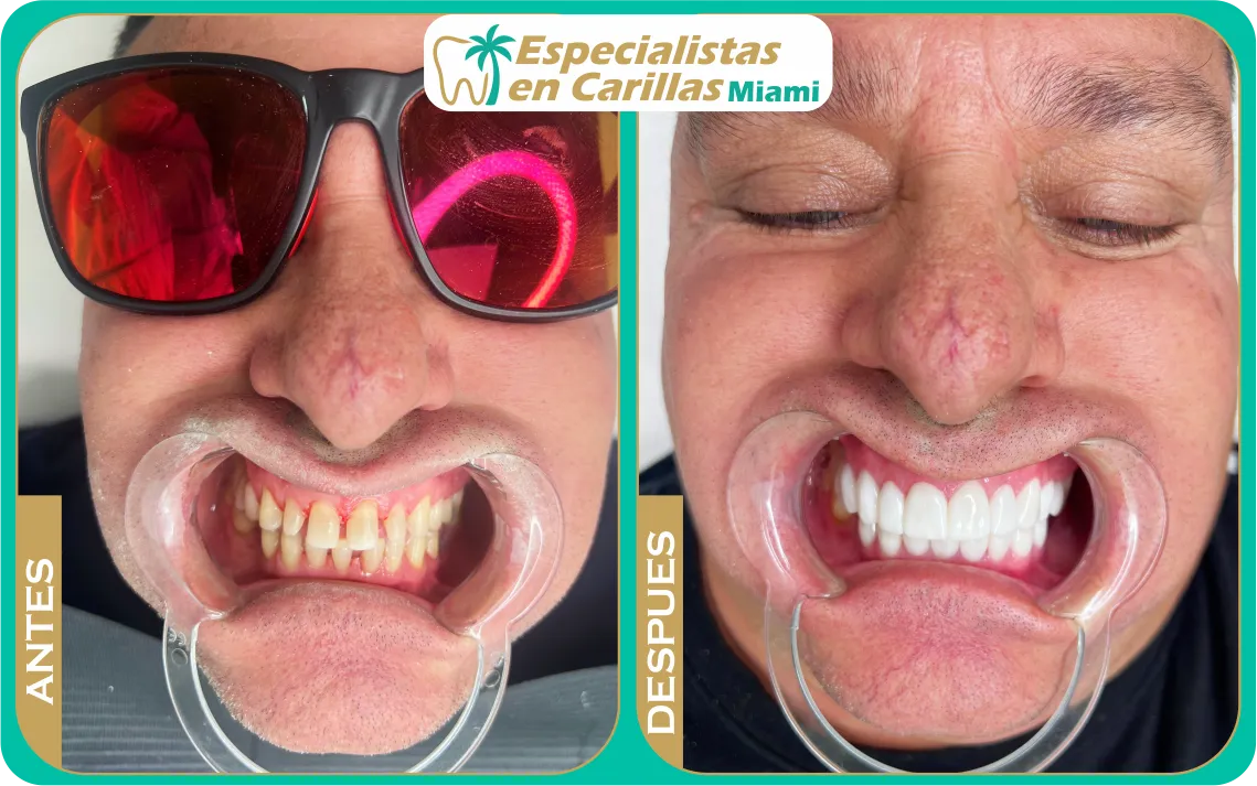 Corrección de dientes desgastados con carillas – Miami
