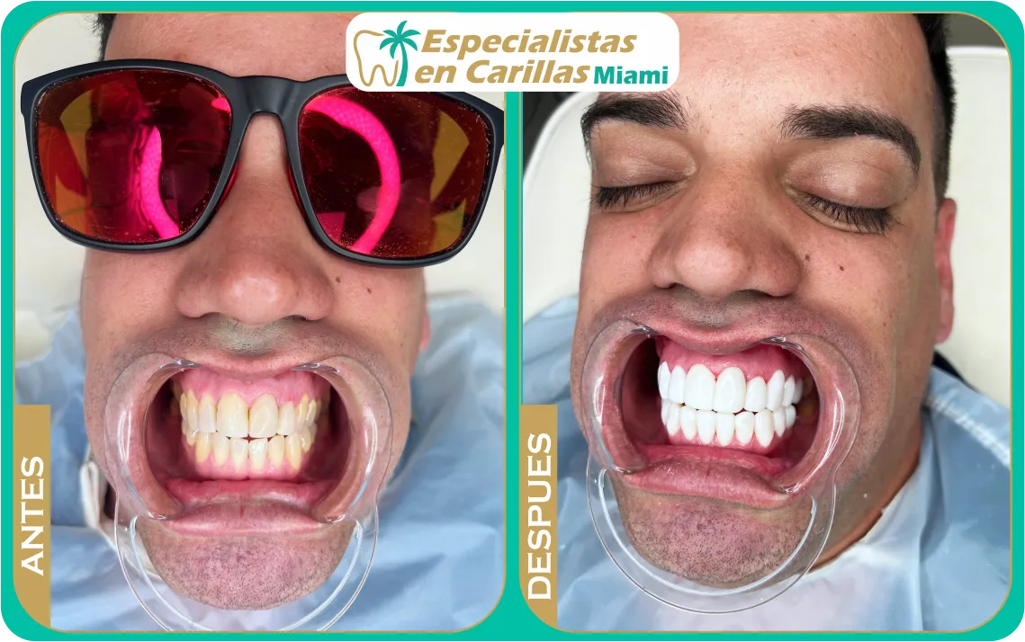 Antes y después coronas estéticas en dientes frontales – Miami