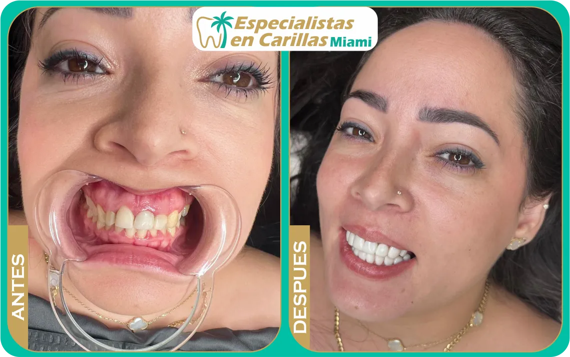 Rehabilitación estética – dientes amarillos a blancos