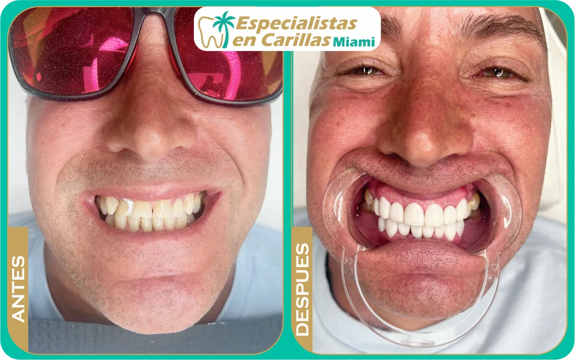 Transformación dental completa con carillas en Miami