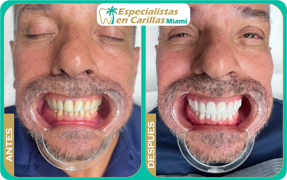 Diseño de sonrisa con carillas de resina – cierre de espacios