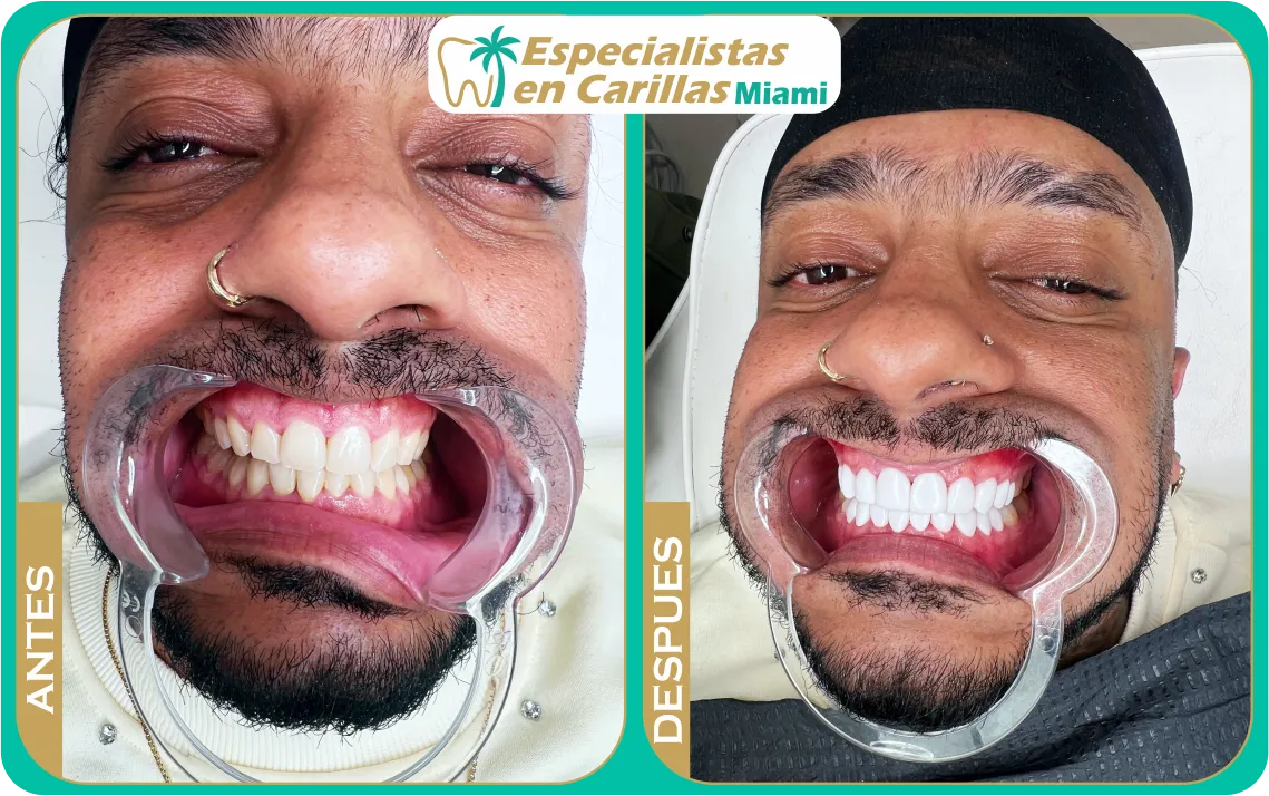 Cambio de sonrisa con carillas dentales estéticas en Miami – resultados naturales